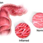 Conferencia Colitis ulcerosa y colon irritable