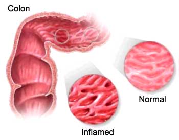 Conferencia Colitis ulcerosa y colon irritable